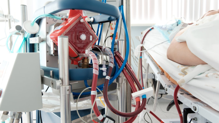 מכונת לב-ריאה ECMO. מספר חולים חוברו לטיפול במכשיר (צילום: Shutterstock)