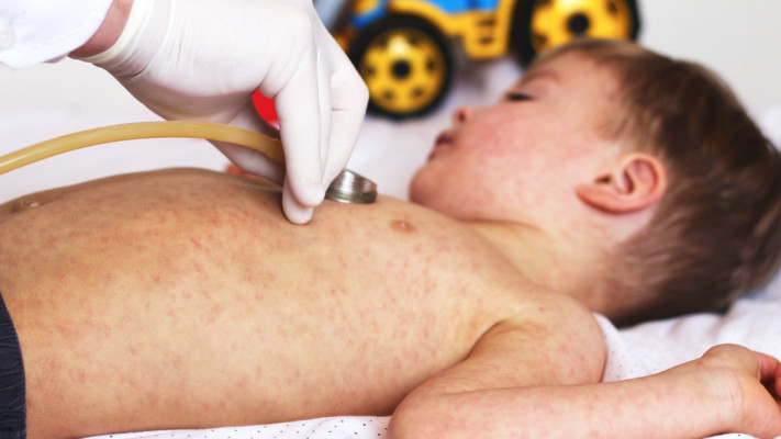 חיסון לחצבת. ירידה בשיעורי ההתחסנות