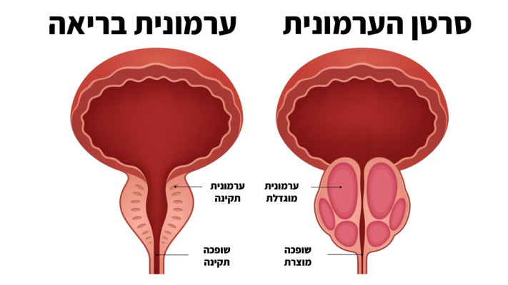 סרטן ערמונית (צילום: איור: מעריב אונליין)