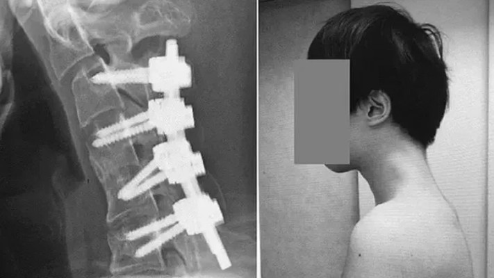 אחרי החדרת הברגים