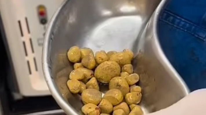 האבנים שנמצאו. דקירות וזיהומים (צילום: אינסטגרם)