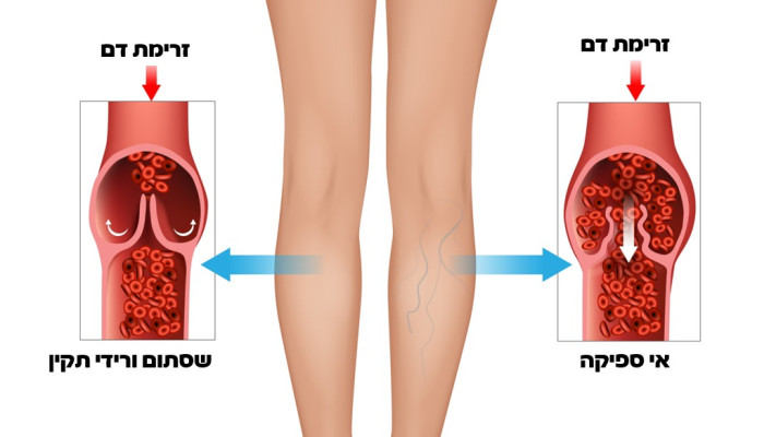 אי ספיקה ורידית. הדם מצטבר ואינו חוזר ללב  (צילום:  שאטרסטוק)