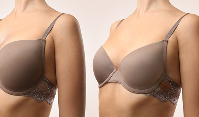 5 things to pay attention to in the “before and after” pictures of breast augmentation