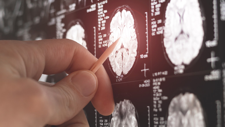 "Delay in Proliferation": The New Weakness Uncovered in the Mechanism of Brain Cancer Spread