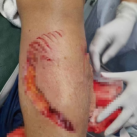 תיירת ננשכה על ידי כריש