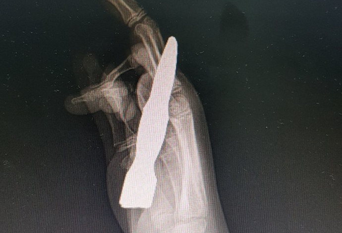צילום של כף היד  (צילום:  מרכז רפואי העמק)