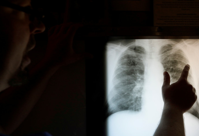 צילום רנטגן של ריאות (אילוסטרציה) (צילום:  רויטרס)