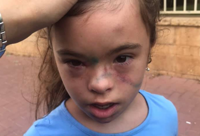 הילדה שהותקפה בצהרון בית הספר בבני ברק (צילום:  צילום מסך מתוך הפייסבוק)