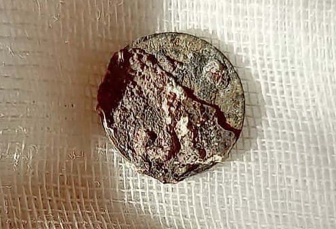 המטבע שנמצא בתוך אפו של המטופל (צילום:  City Clinical Hospital named after M. Konchalovsky)