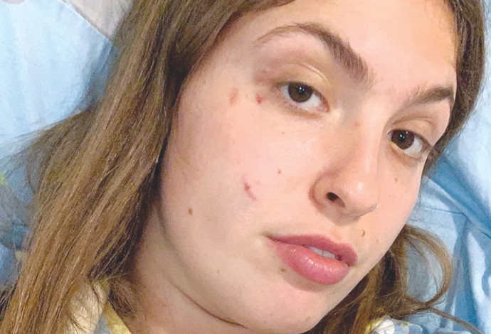 הצעירה שהותקפה על ידי פיטבול (צילום:  באדיבות המצולמת)