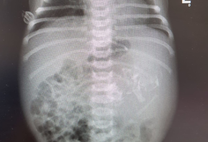 צילום הרנטגן בו נראה עובר בתוך בטנה של התינוקת (צילום:  אסותא אשדוד)