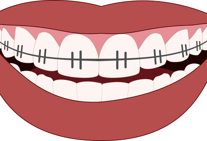 כל השיטות ליישור שיניים (צילום:  Pixabay)