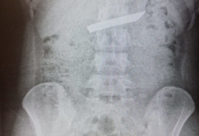צילום רנטגן, בו ניתן לראות את להב הסכין בבטן העליונה  (צילום:  דוברות המרכז הרפואי לגליל)