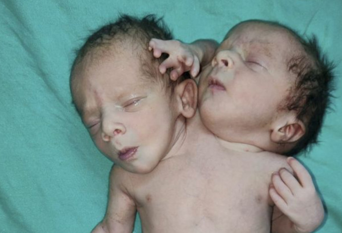זוג התאומים התגלה כתינוק אחד עם שני ראשים ושלוש זרועות (צילום:  Ratlam hospital)
