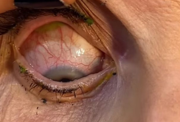 מה שהיה בעין של המטופלת זעזע את הרופאה (צילום:  מתוך אינסטגרם)