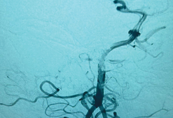 צילום הדמיה, בו ניתן לראות את החסימה באחד מעורקיה המוח (צילום:  המרכז הרפואי לגליל)