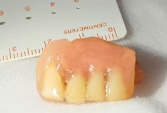פלטת תותבת השיניים של הגבר בשנות ה-50 לחייו (צילום:  דוברות מרכז רפואי "מאיר" מקבוצת "כללית")