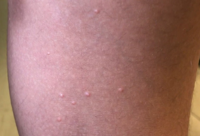 זיהום העור "מולוסקום קונטגיוזום" (צילום:  ד"ר איתי גל)