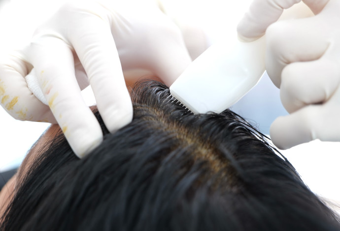 הזרקת שיער סינטטי בקרקפת  (צילום:  היירסטטיקס)