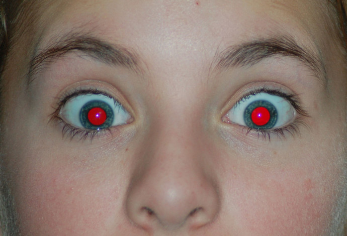 עיניים אדומות בצילום בפלאש (צילום:  ויקיפדיה)