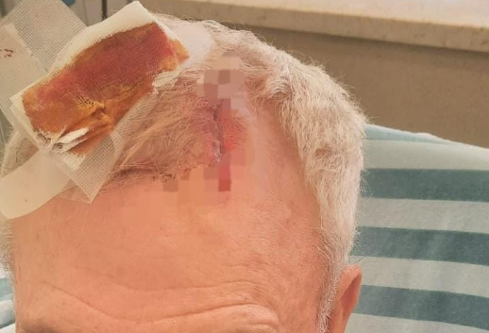 בן ה-73 שהותקף בבקבוק זכוכית על ידי רוכב אופנוע (צילום:  דוברות המשטרה)