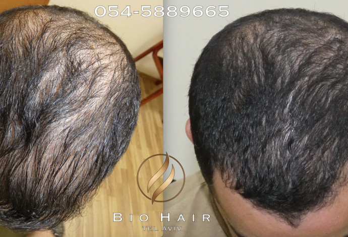 הקרב על השיער (צילום:  BioHair )