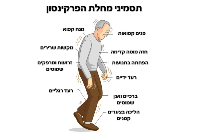 תסמיני מחלת הפרקינסון. רעד ונוקשות (צילום:  שאטרסטוק)