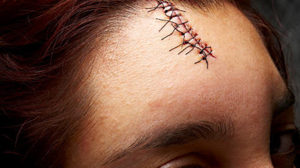 תפרים בראש, אילוסטרציה (צילום: Getty images)