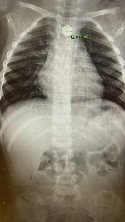 צילום רנטגן של בית החזה של הילד