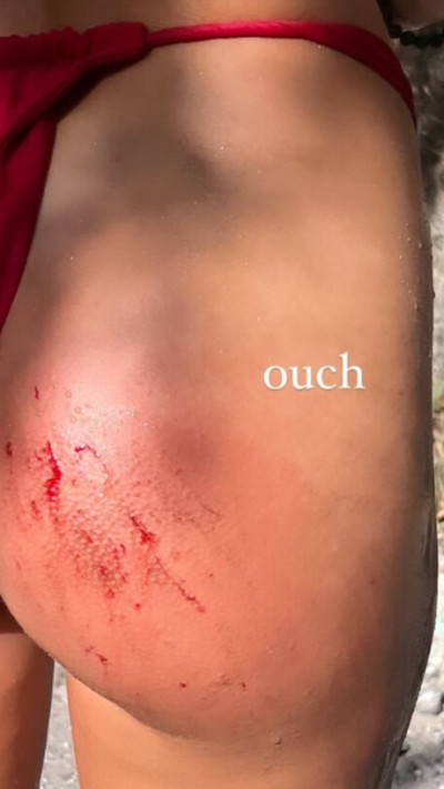 אלה איילון נפצעה בישבנה (צילום: צילום מסך מתוך האינסטגרם)