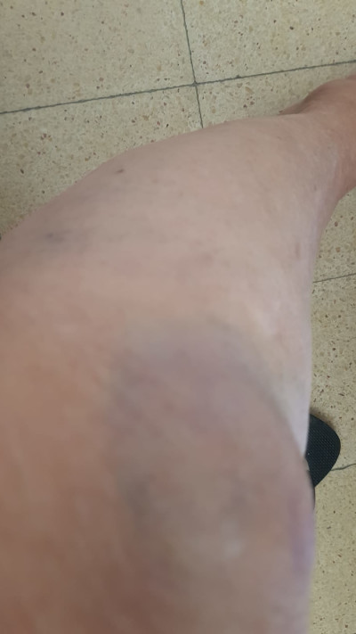 יהודית באומן נפצעה במהלך האזעקה  (צילום: פרטי)