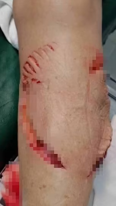 תיירת ננשכה על ידי כריש