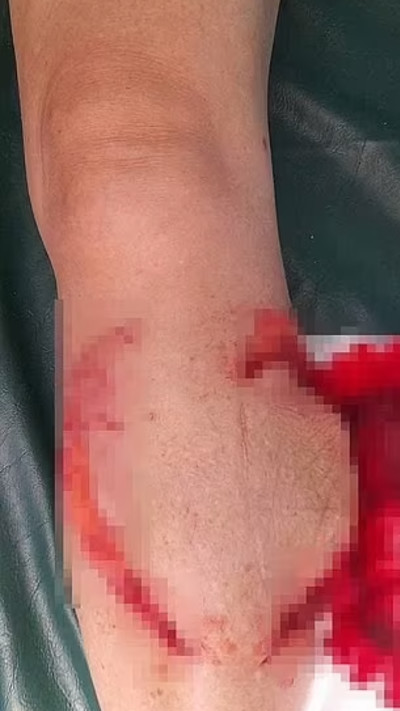 תיירת ננשכה על ידי כריש