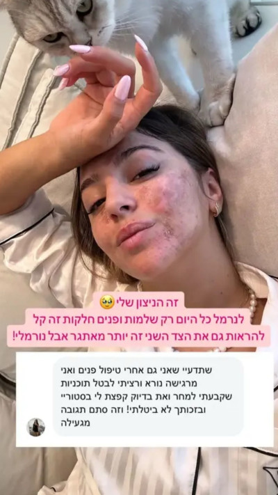 אור שפיץ אחרי טיפול פנים (צילום: מתוך אינסטגרם)