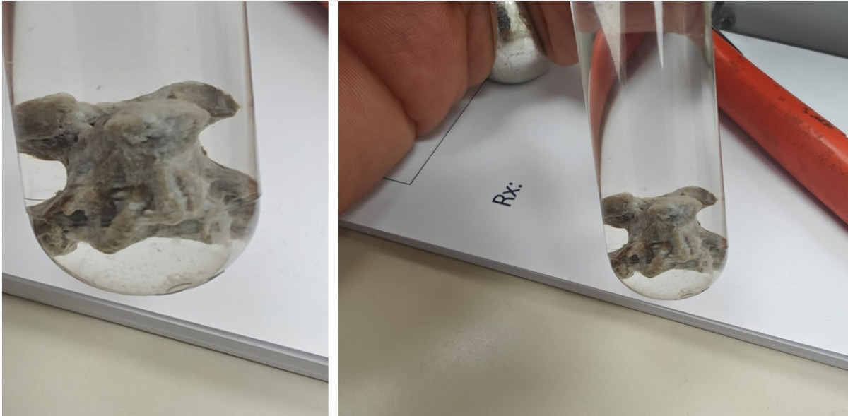 The cause of the acute pneumonia: drinking chicken soup