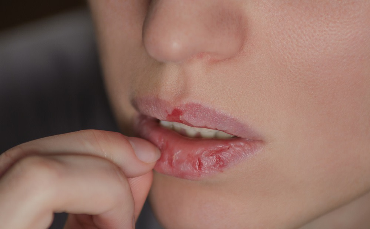 Feeling dry lips? You are not alone – all the causes and treatments Dr. Gal