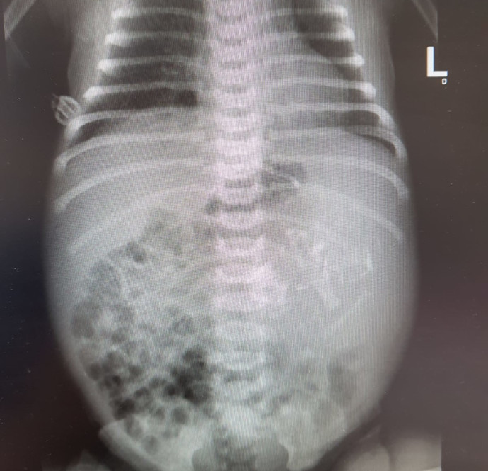 צילום הרנטגן בו נראה עובר בתוך בטנה של התינוקת (צילום: אסותא אשדוד)