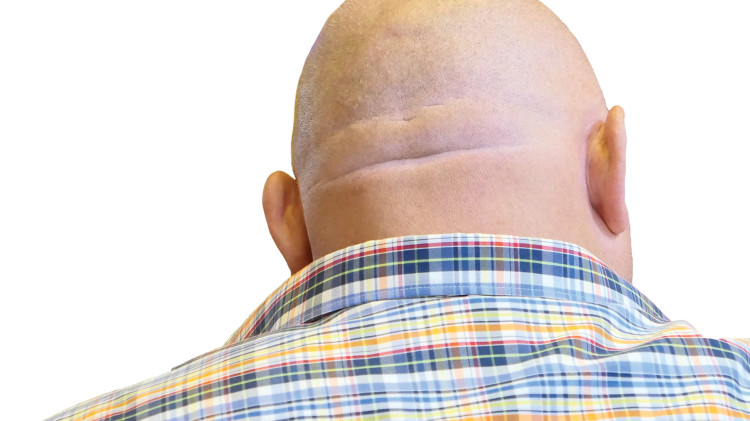 קרחת (צילום: אינג אימג')