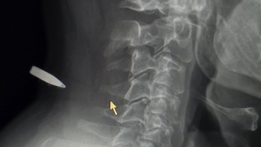 צילום הרנטגן של הכדור שנתקע בצווארו