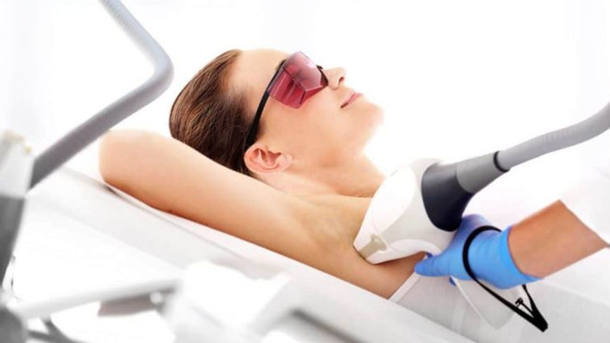 הסרת שיער בלייזר