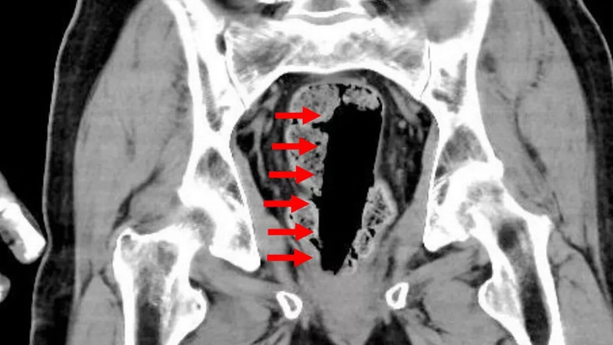 קשיש החדיר בקבוק דבק לישבן