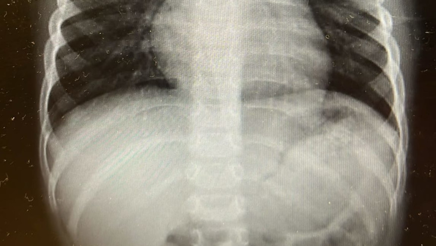 צילום רנטגן של בית החזה של הילד