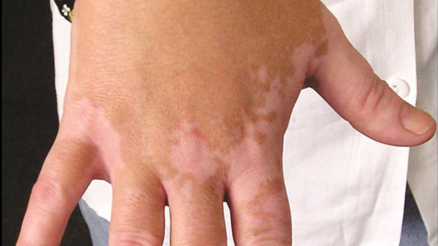 בעיות פיגמנטציה