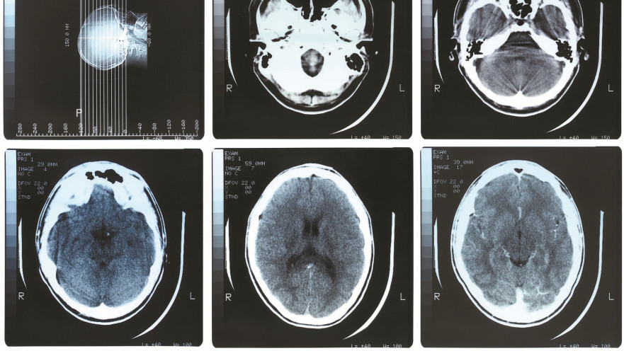 חלקיקי זיהום אוויר במוח