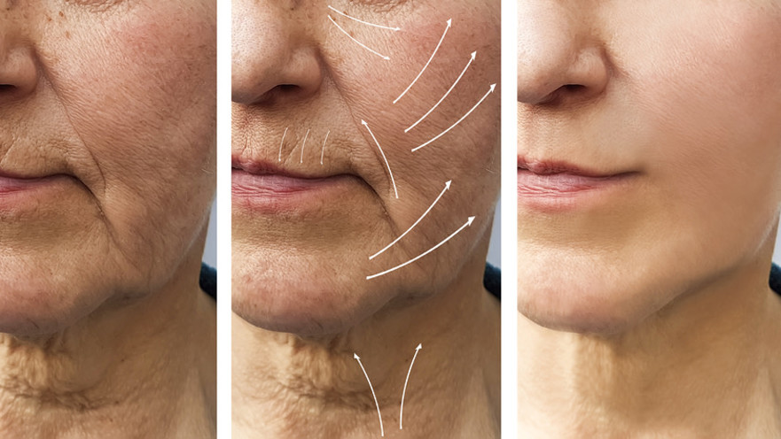 העלמת קמטים