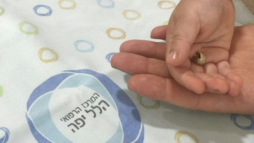 החילזון שנשלף מאפו של פעוט