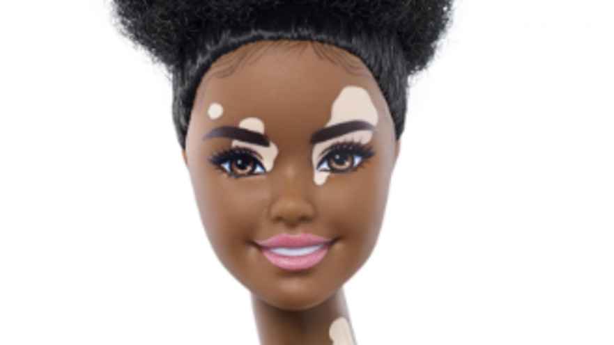 ברבי עם מחלת ויטליגו