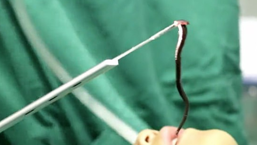 העלוקה נשלפת מגרונו של ילד בסין