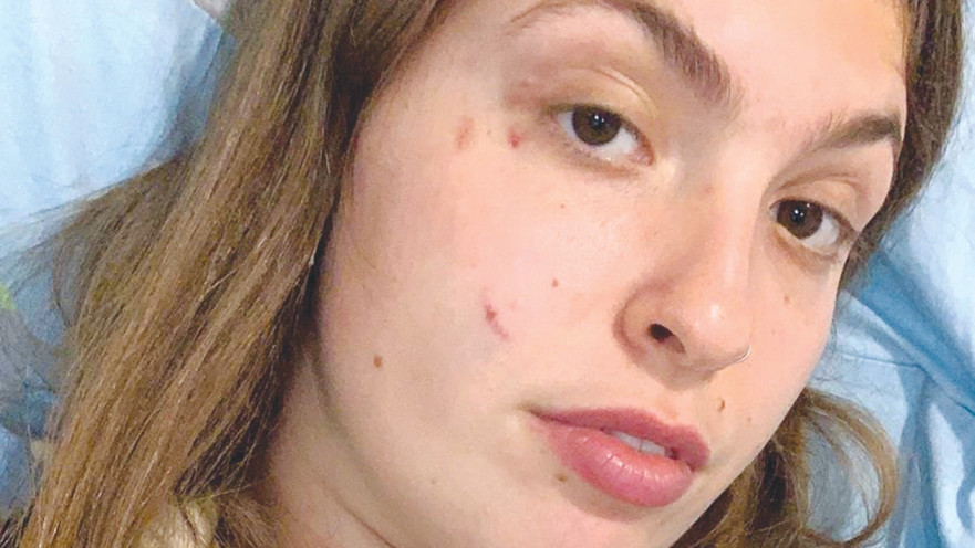 הצעירה שהותקפה על ידי פיטבול