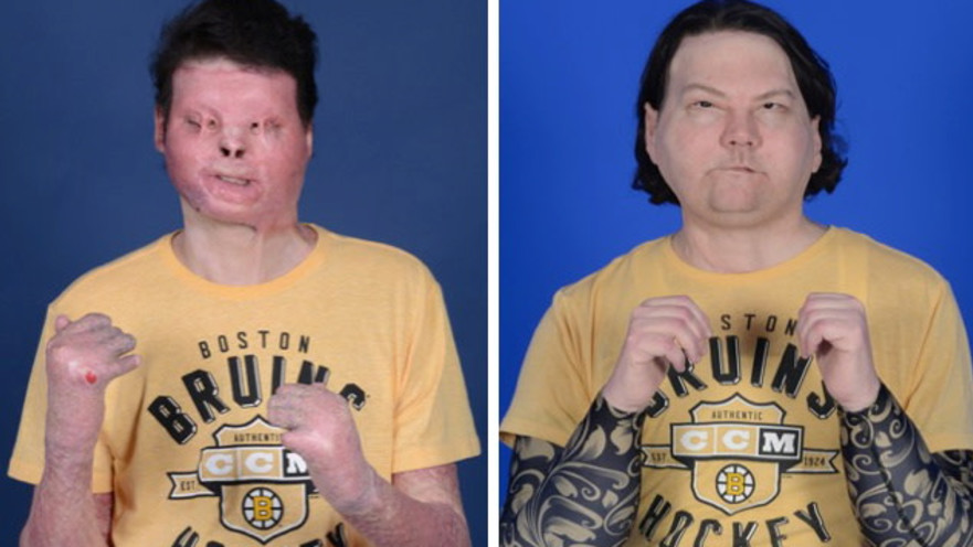 לפני ואחרי, הניתוח להשתלת פנים הראשון בעולם